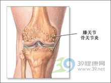 色素絨毛結節性滑膜炎