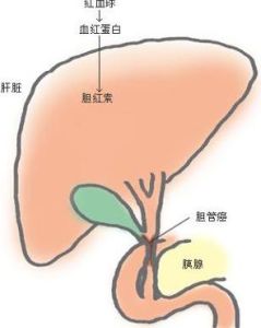 膽道梗阻