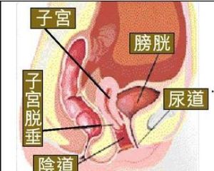 膀胱脫垂