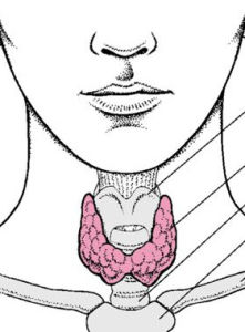 橋本式甲狀腺炎