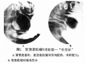 （圖）胃脂肪瘤