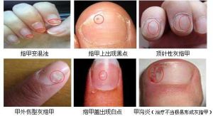 甲溝炎中醫療法 甲溝炎中醫療法