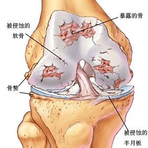 風濕免疫病