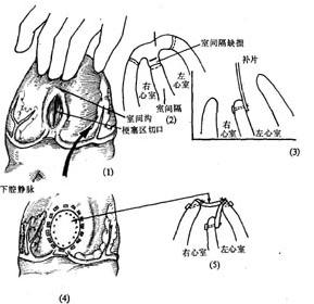 心肌梗塞並發心室間隔穿破