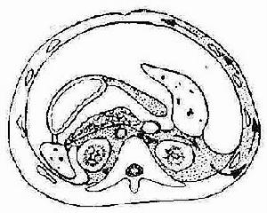 急性出血壞死型胰腺炎