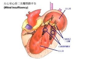 二尖瓣閉鎖不全