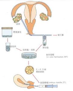 體外受精