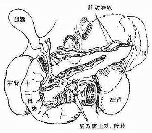 結石性膽囊炎