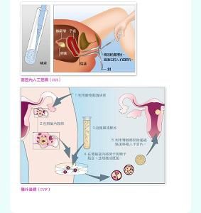 人工授精