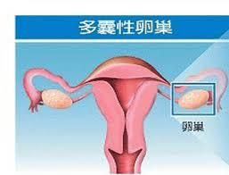 多囊性卵巢囊腫