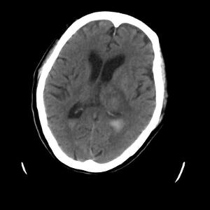 自發性腦室內出血