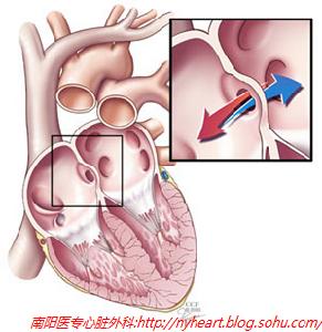 先天性風疹