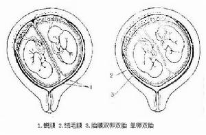 單卵雙胎