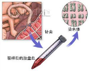 臍突病