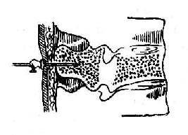 脊椎棘突穿刺術