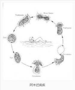慢性阿米巴痢疾