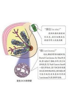 乳腺導管內原位癌