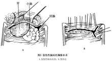 膈疝手術