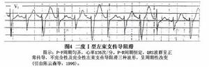 左束支傳導阻滯