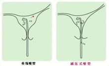 微管可視無痛人流