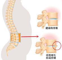 跟骨刺