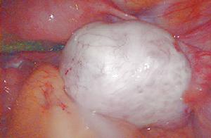 卵巢冠囊腫