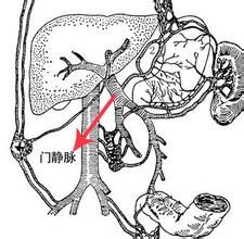 門靜脈血栓形成