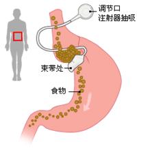 胃束帶手術示意圖