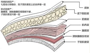 新式剖宮產術