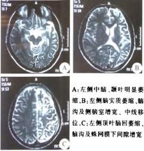 Rasmussen綜合徵