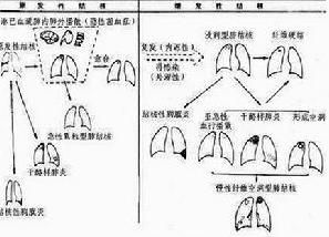 原髮型肺結核