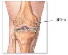 褐黃病性關節炎