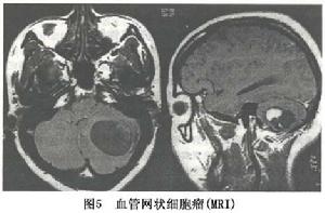 （圖）腦內血管網狀細胞瘤