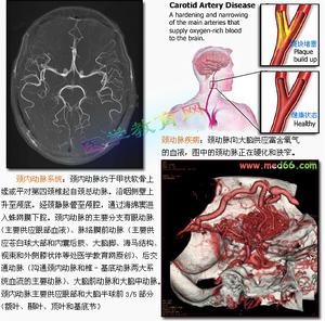頸內動脈閉塞綜合徵