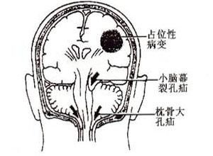 占位病變