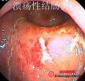 慢性潰瘍性結腸炎