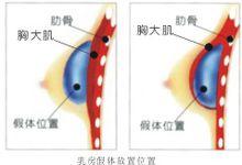 假體豐胸