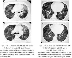 間質性肺炎