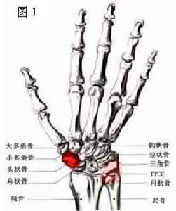 月狀骨骨軟骨病