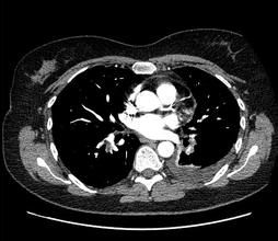 CT肺動脈造影