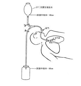 肺灌洗手術