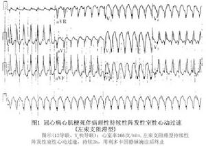 病理性陣發性室性心動過速