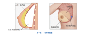 乳暈矯正手術