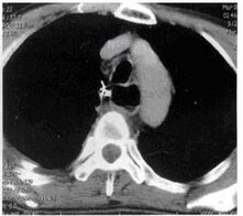 食管平滑肌瘤CT影像