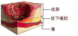 淺度潰瘍期