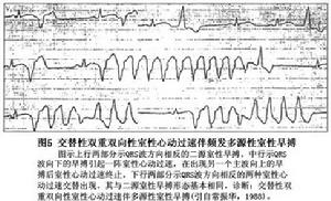 雙向性室性心動過速