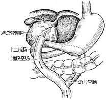 先天性膽總管囊腫