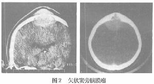 矢狀竇旁腦膜瘤