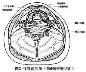 氣管前間隙感染