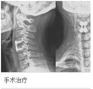 混合型頸椎病